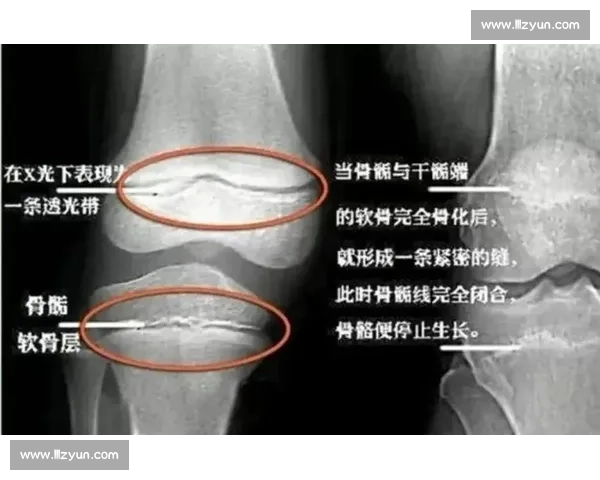 18 岁骨骺线未闭合?科学 3 招助你再长高 5cm 18 岁骨骺线未闭合?科学 3 招助你再长高 5cm
