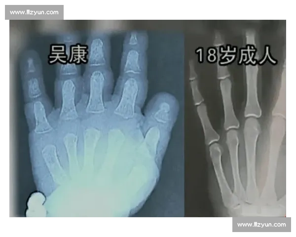 18 岁骨骺线未闭合?科学 3 招助你再长高 5cm 18 岁骨骺线未闭合?科学 3 招助你再长高 5cm